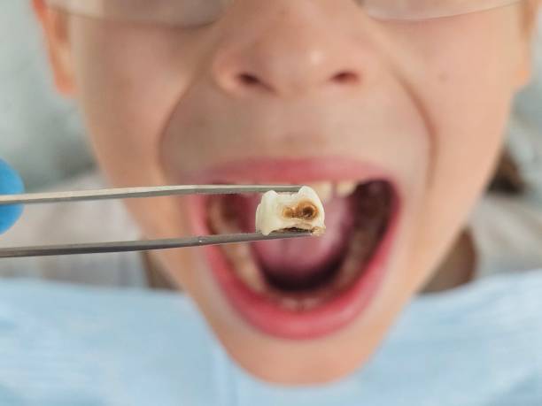 Best Broken or Cracked Tooth Emergency Dentist in Charenton, LA